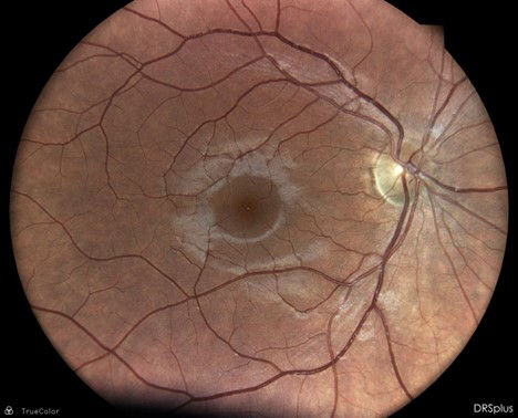  Prikazani snimci predstavljaju primjere nalaza očnog dna zabilježenih fundus kamerom tokom rutinskog teleoftalmološkog skrininga u realnoj kliničkoj praksi
