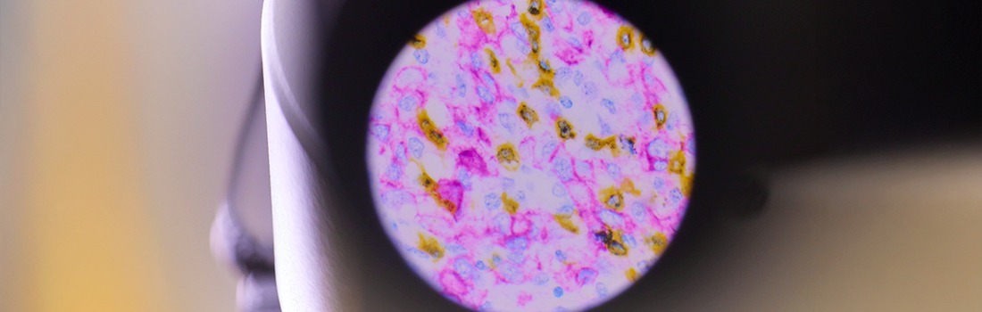neuronas artificiales contra alzheimer