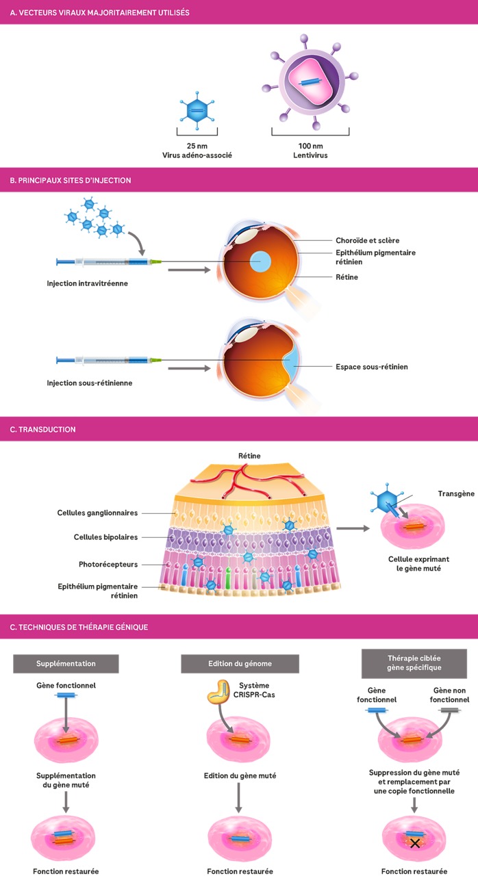 Schéma des différentes étapes d’une thérapie génique en ophtalmologie