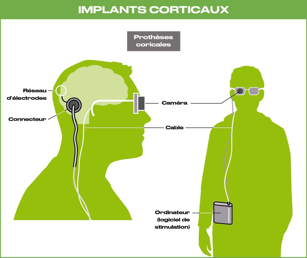 Schéma d’un implant cortical