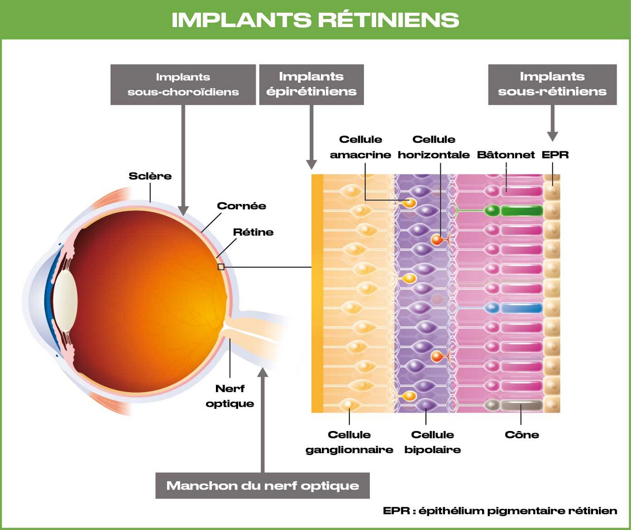 Schéma d’un implant rétinien