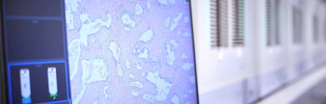 predictor riesgo cáncer de mama