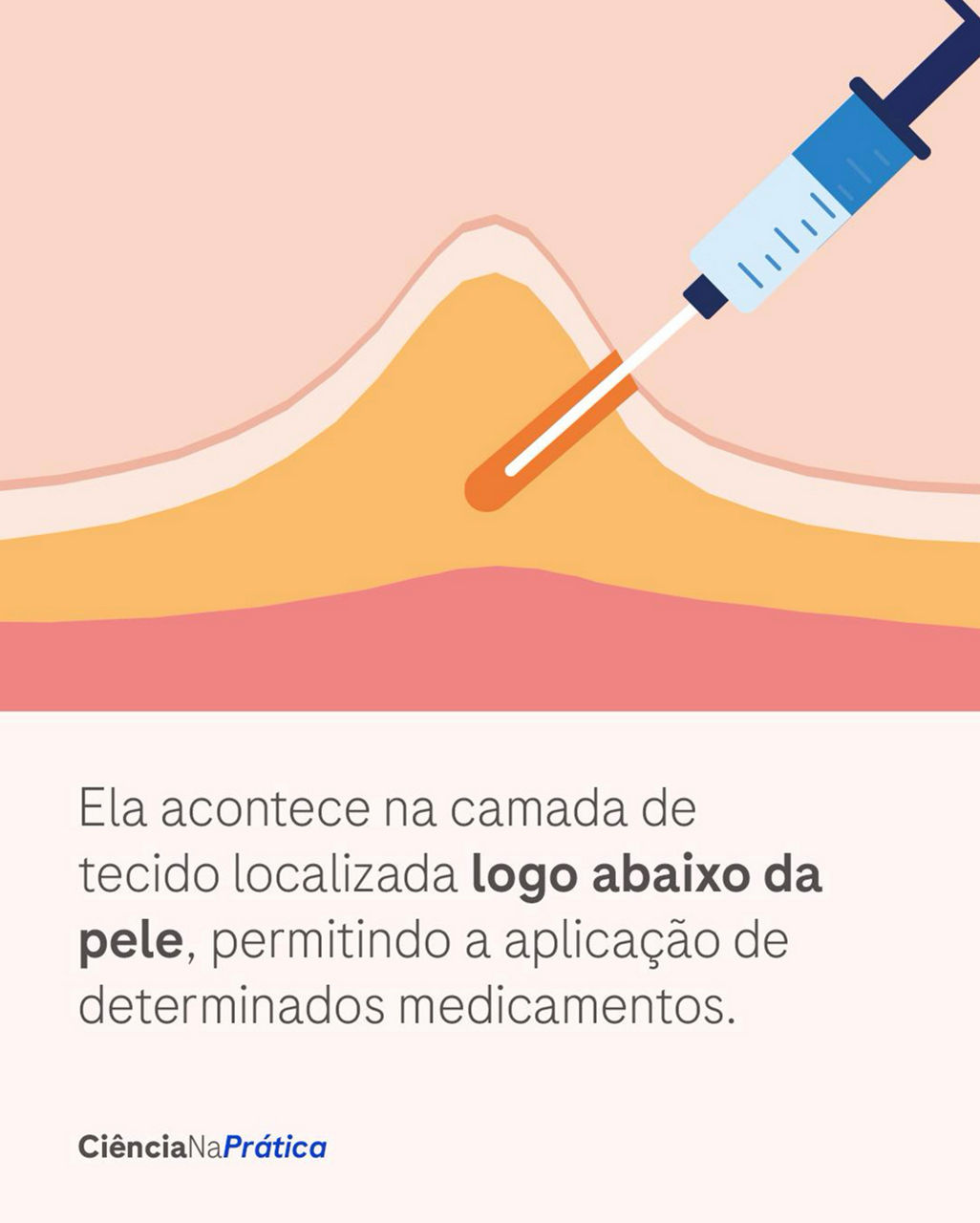 Ela acontece na camada de tecido localizada logo abaixo da pele, permitindo a aplicação de determinados medicamentos..