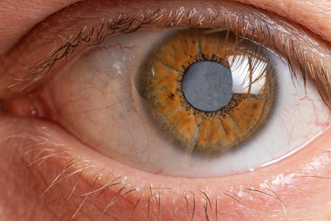 ojo con cataratas