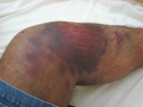 clasificare-hemofilie-2