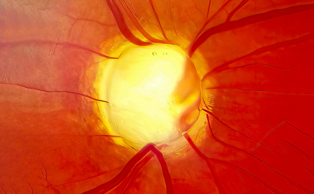 ojo con glaucoma
