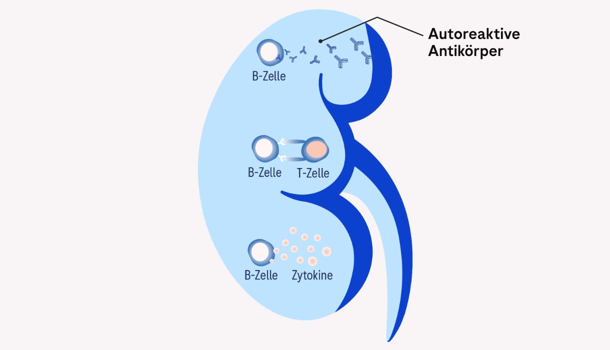 Illustration einer Niere, die die zentrale Rolle autoreaktiver B‑Zellen in der Pathogenese der Lupus Nephritis zeigt, einschließlich Produktion autoreaktiver Antikörper und Entstehung von Entzündungen.