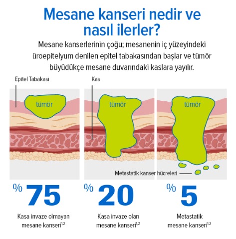 Mesane Kanseri_Image 3