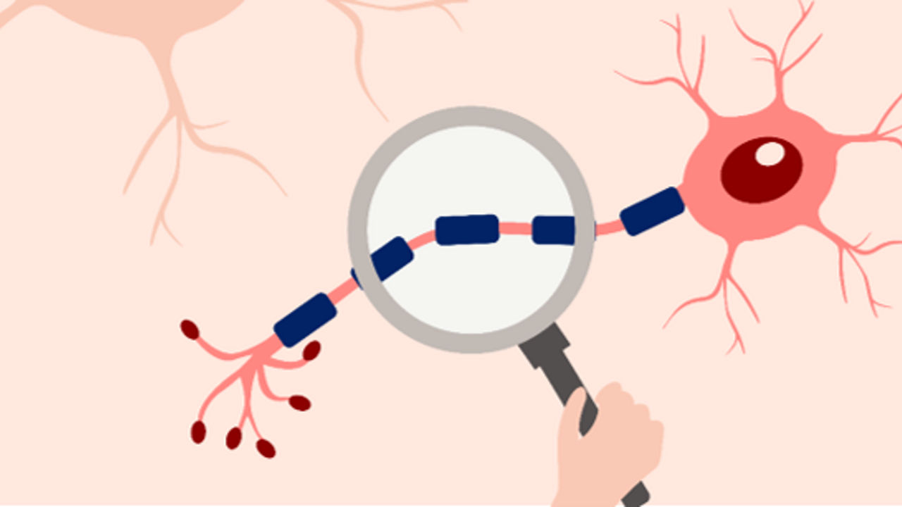 Illustration, die den Demyelinisierungsprozess an einem Neuron zeigt. Eine Lupe vergrößert die beschädigte Myelinscheide am Axon