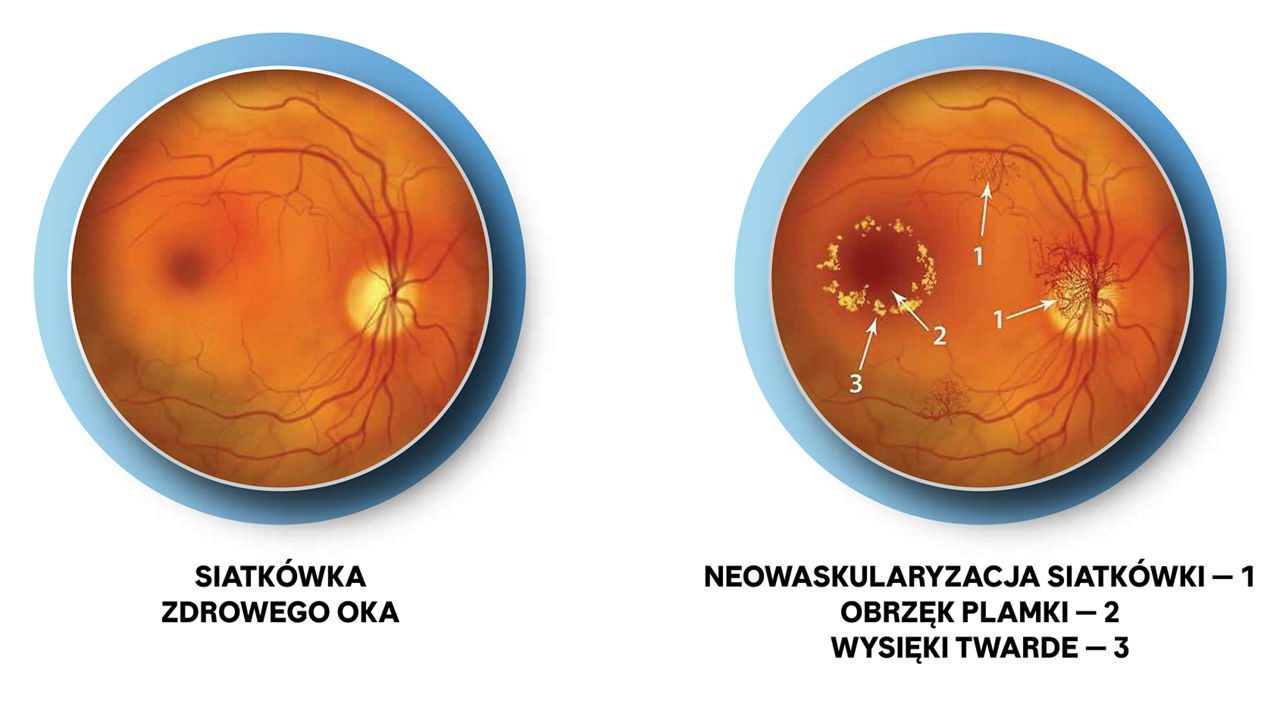 Rozwój cukrzycowego obrzęku plamki (DME)