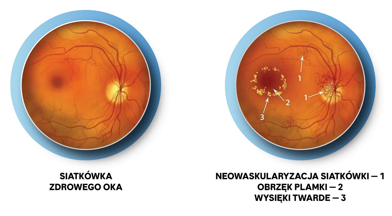 Rozwój cukrzycowego obrzęku plamki (DME)