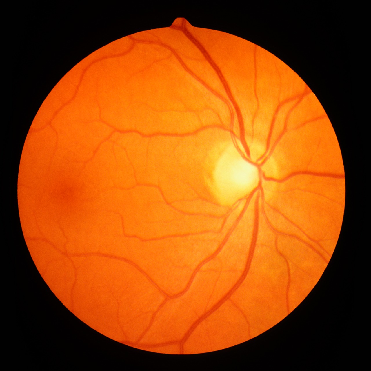 ojo con drusas de tamaño medio en la macula