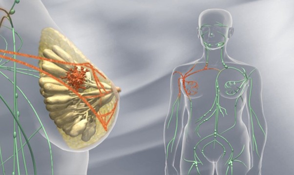 avastin-in-cancerul-mamar