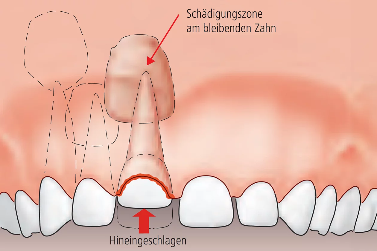 Milchzahn hineingeschlagen