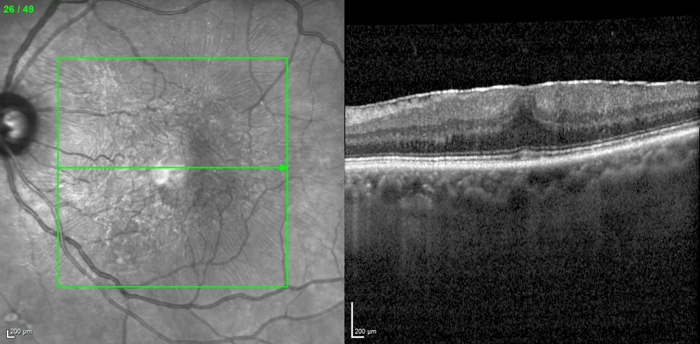Epiretinale Fibroplasie