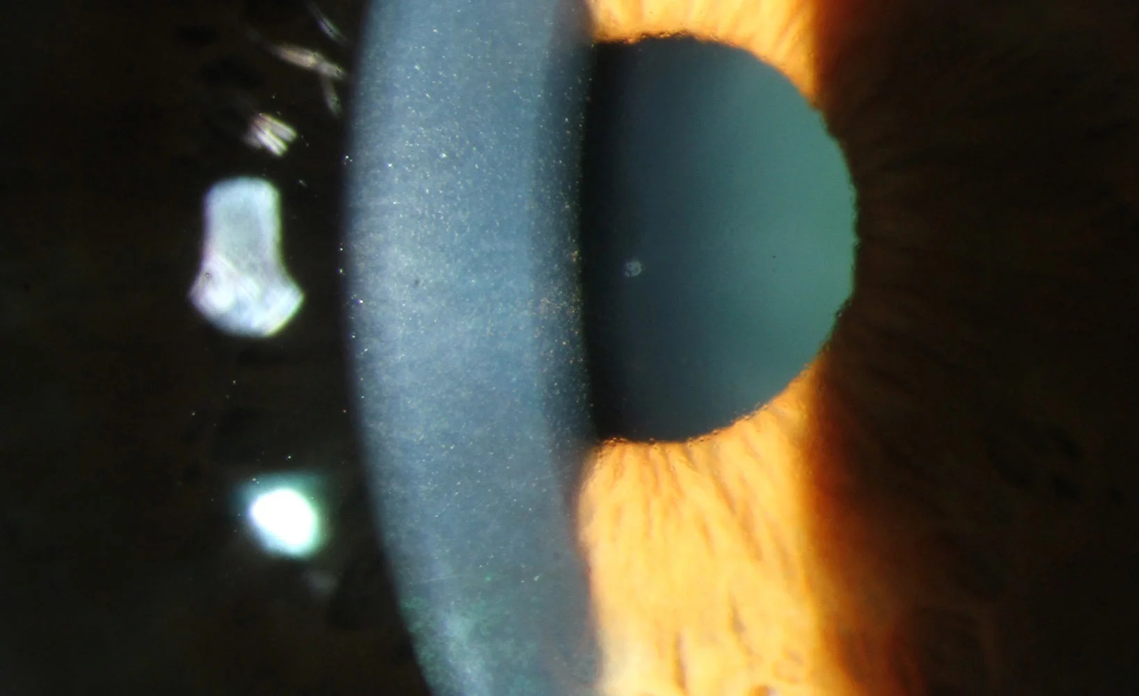 Fuchs-Endotheldystrophie