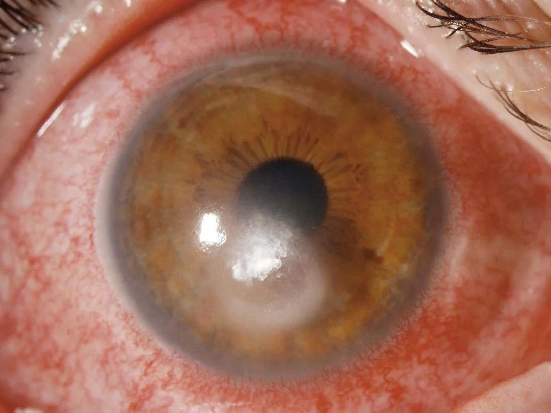 Hornhautentzündung (Keratitis)