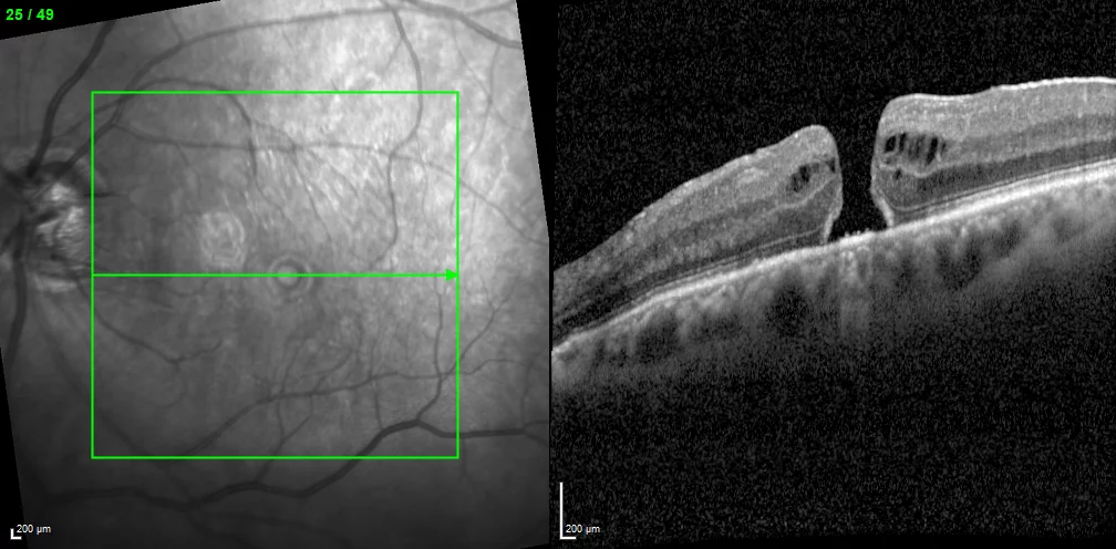 Makulaforamen