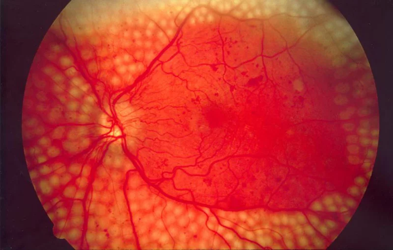 Panretinale Laserkoagulation (PRP)