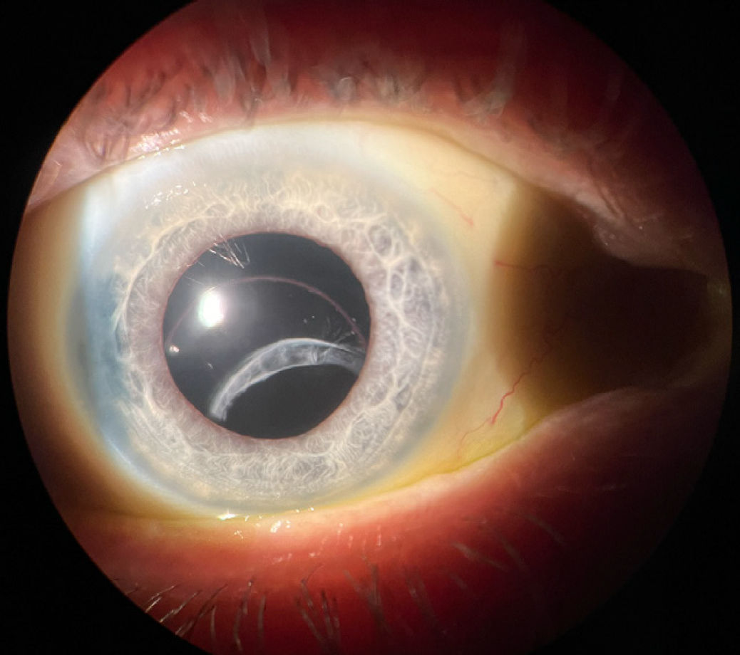 Dislozierte Intraokularlinse (IOL) / Linsenluxation