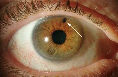 YAG-Iridotomie