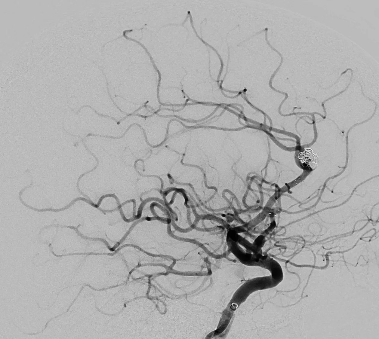 Angiographie