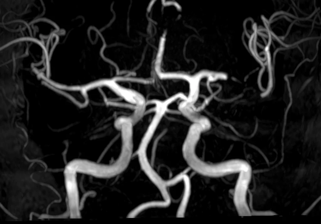 Angiographie (Darstellung der Gefässe mit Kontrastmittel)