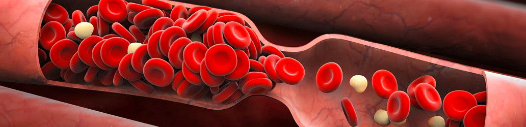 Verängung der Arterie, Blutblättchen kommen nicht durch