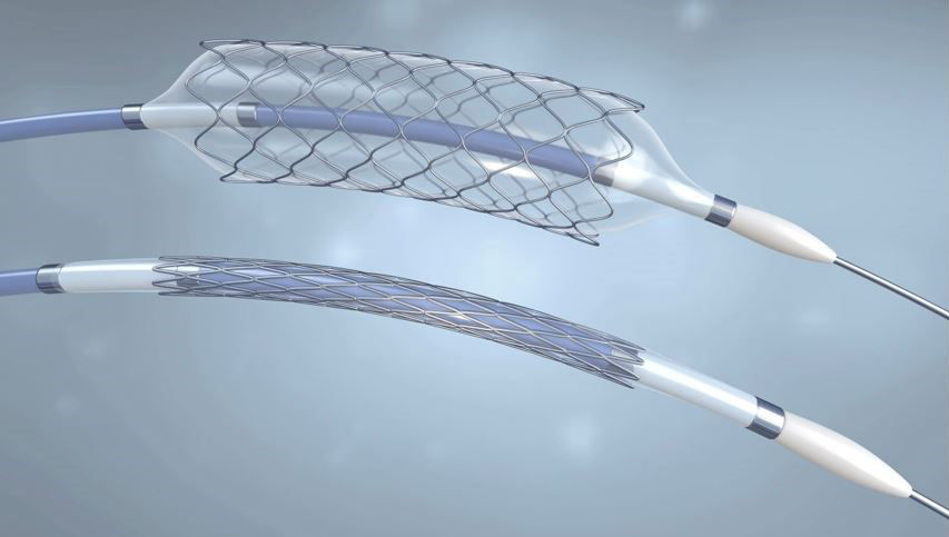 Ein Bild das zeigt wie ein Stent offen und geschlossen aussieht