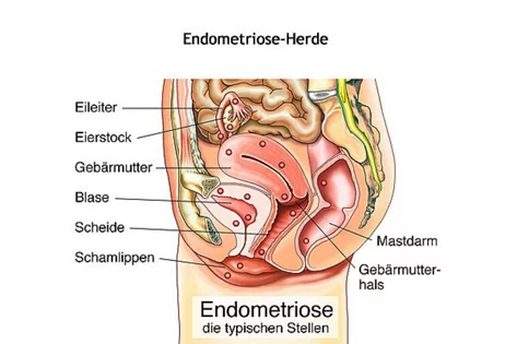 Endometriose-Herde