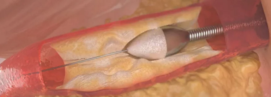 Nahaufnahme eines Rotablators