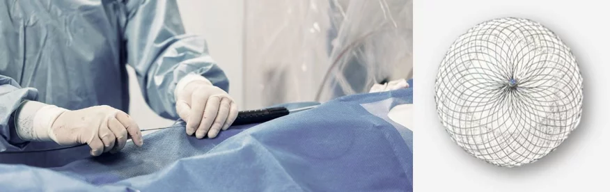 Nahaufnahme PFO-Schirm und Symbolbild für operativen Eingriff