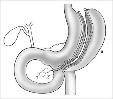 Sleeve-Gastrektomie